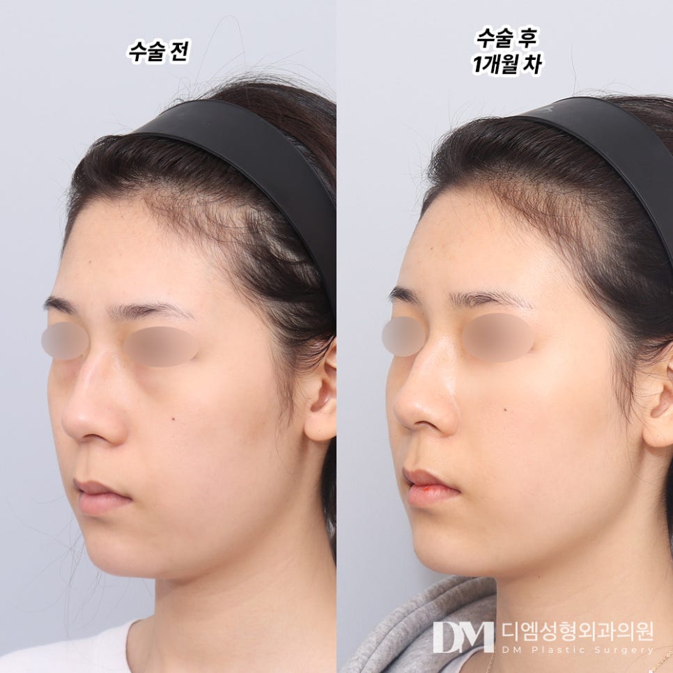 Facial Fat Grafting: Adding Natural Volume to the Face image 6