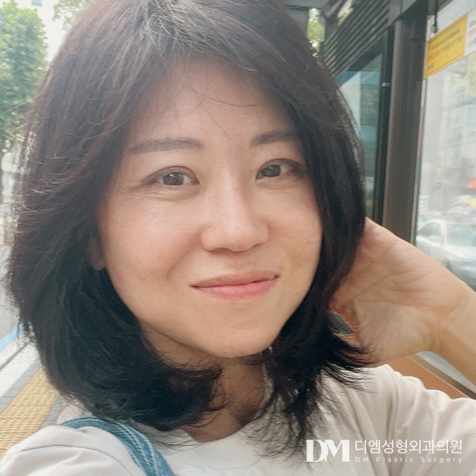 디엠 안면거상 전후사진, 잃어버린 자신감과 탄력 되찾기! 관련 이미지 3