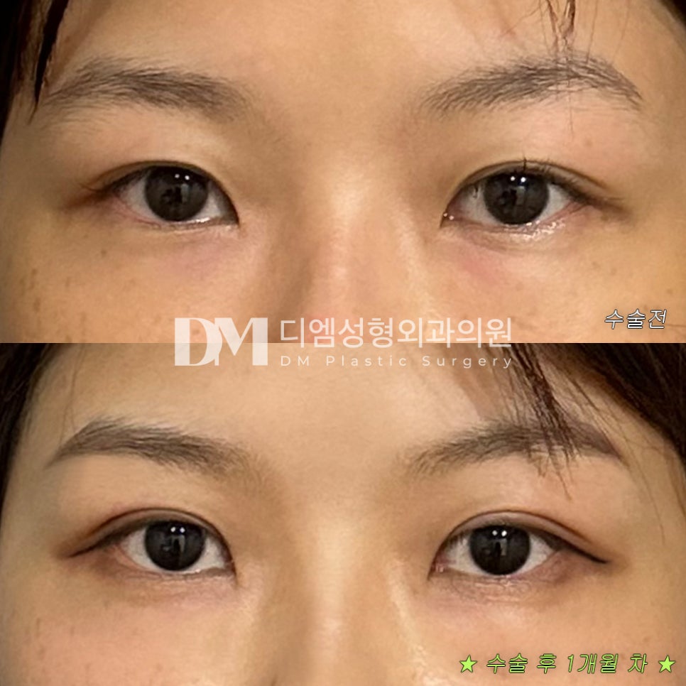 Review of Revision Eye Surgery. "I’m satisfied with the results, and people around me have often said it looks good!" image 2