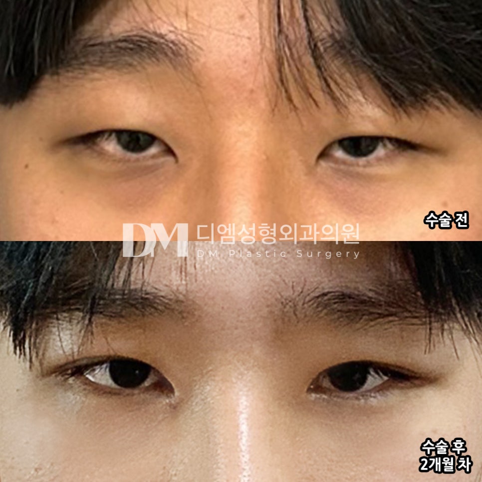 Eyelid Surgery Review: “It’s becoming more natural, and it feels as comfortable as if these were my original eyes!” image 2