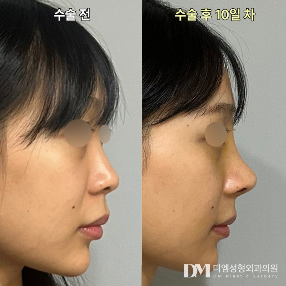 코끝성형, 입체적인 얼굴로! 관련 이미지 8
