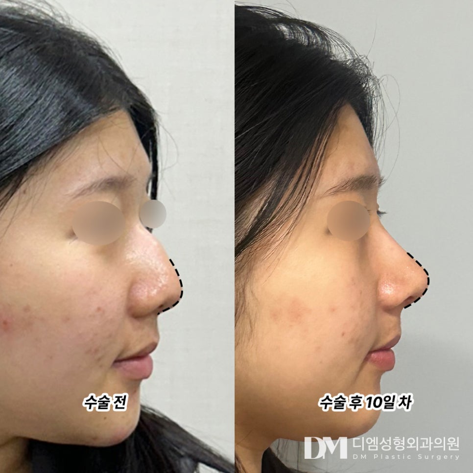 The Secret to Creating a High Nose Bridge, Nasal Tip Surgery image 8