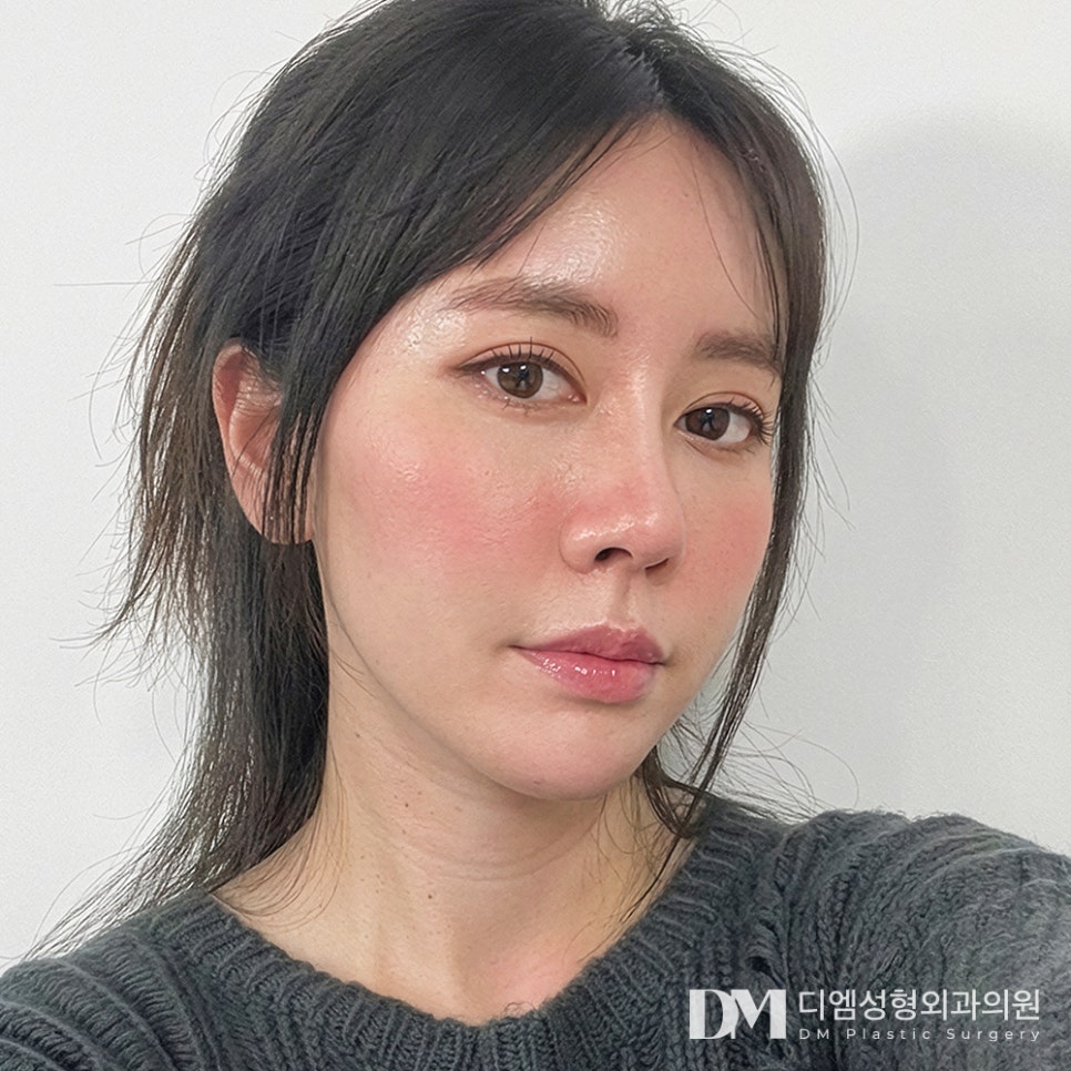 뒤밑트임 전후사진, 답답하고 사나운 눈매 개선 가능할까? 관련 이미지 3