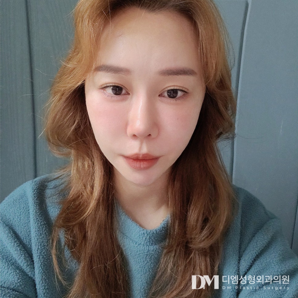 반거상, 안면거상의 차이와 고려해볼 사항은? 관련 이미지 14