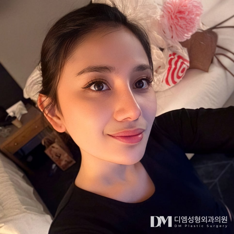 눈매교정, 겹주름 진 눈두덩이로 피곤해 보인다면? 관련 이미지 15