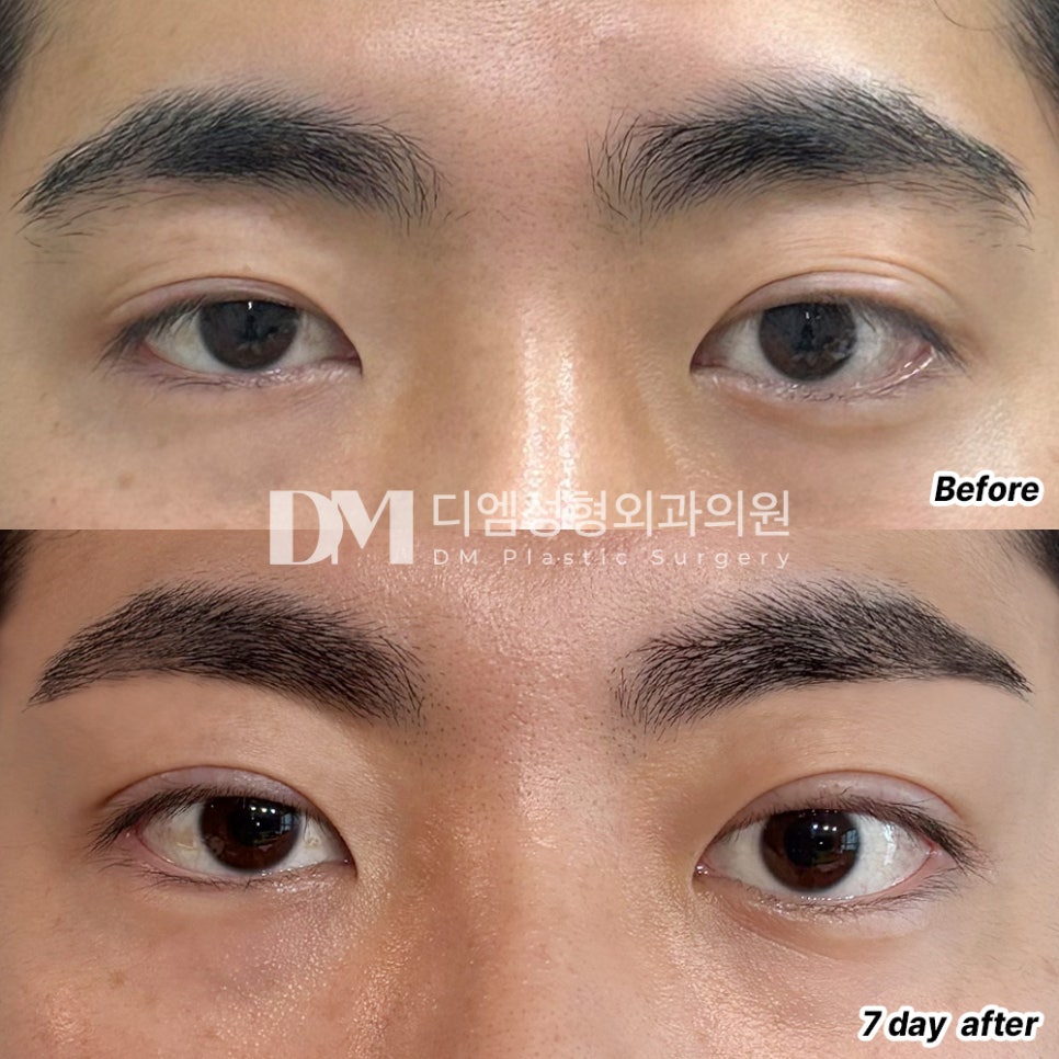 Revision Eyelid Surgery Review. "The director was thorough and it seemed like it wasn’t a factory-style clinic, so I felt confident!" image 2