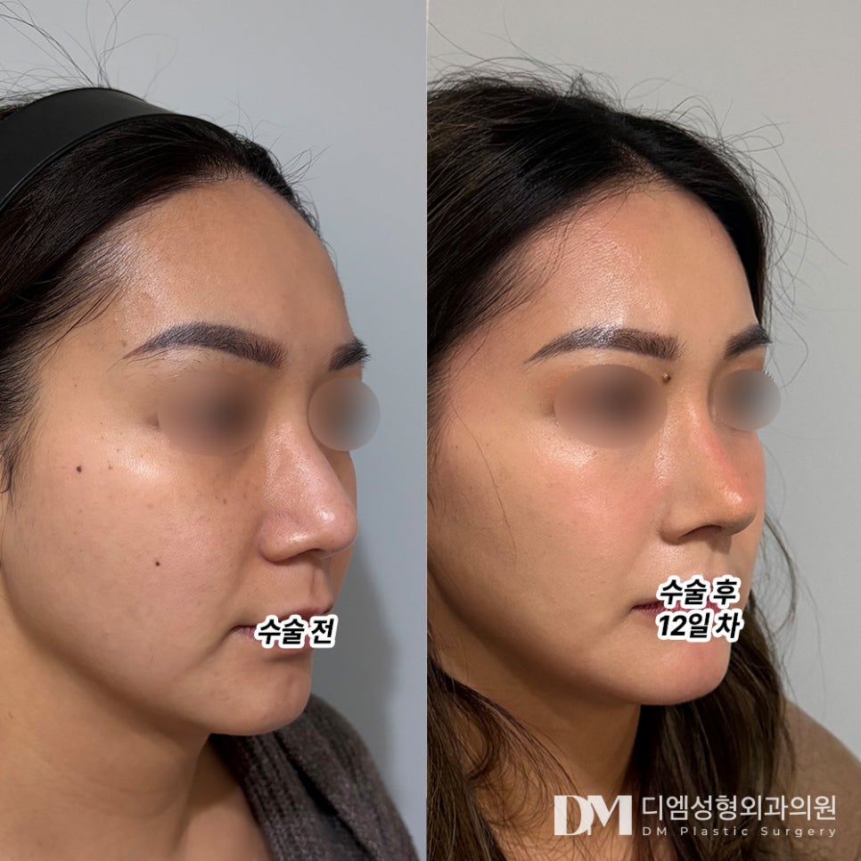 Revision Rhinoplasty, So It Can Be Your Last Nose Surgery image 10