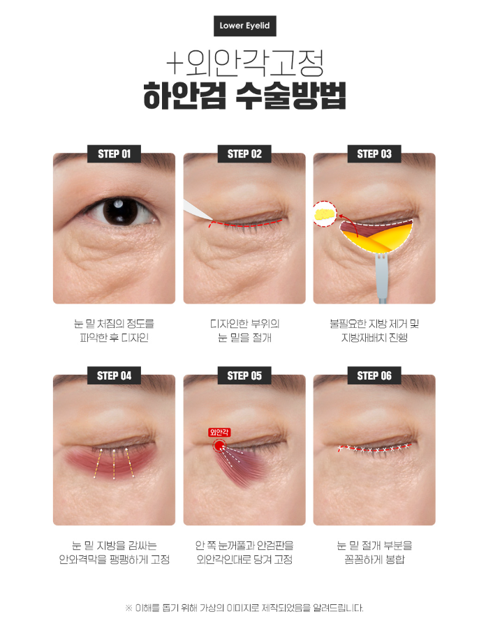 하안검으로 밝은 인상 만들기 관련 이미지 9