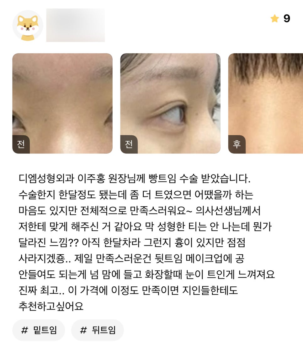 Lateral Canthoplasty Review. “What I’m most satisfied with is that I don’t have to put much effort into makeup for the outer corners of my eyes anymore. I can really feel that my eyes look more open when I do my makeup—it’s truly the best..” image 1