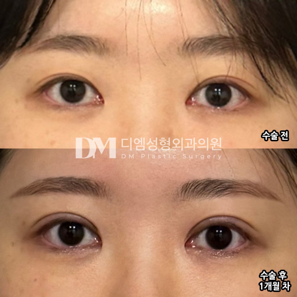 눈재수술 후기."거울 볼 때 마다 크고 또렷해진 눈이 너무 맘에 듭니다!" 관련 이미지 2