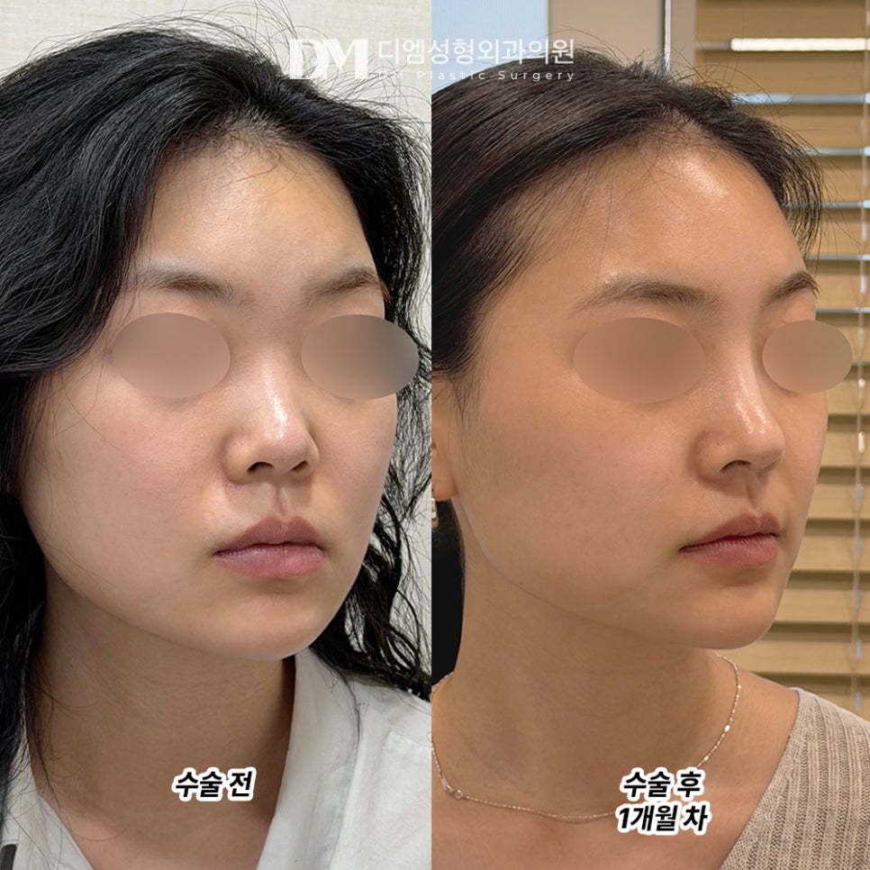 DM Rhinoplasty Review, “I’m Really Satisfied That It Was Designed in a Way That Suits My Face!” image 2