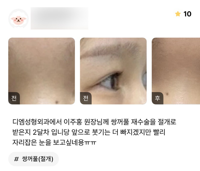 Double Eyelid Revision Review: “I Want to See My Eyes Settled Quickly!” image 1