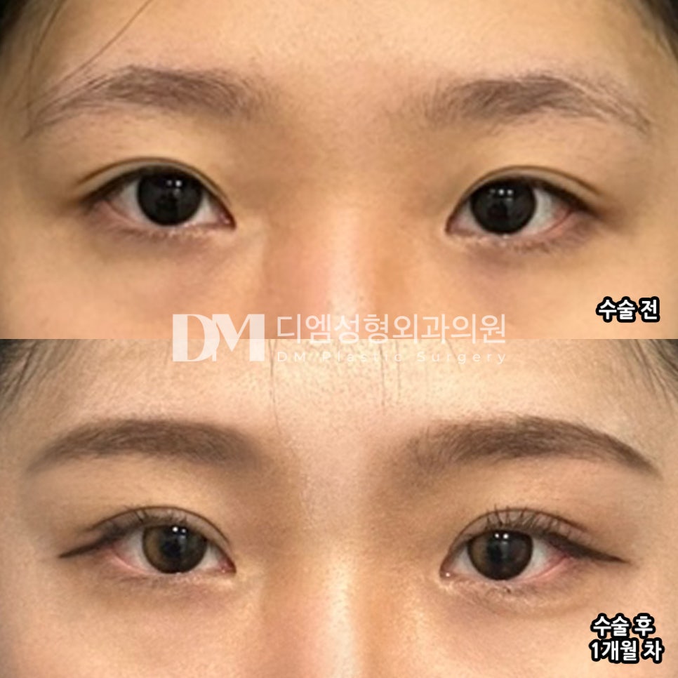 눈재수술 후기."주변사람들도 자연스럽대요 ~!" 관련 이미지 2
