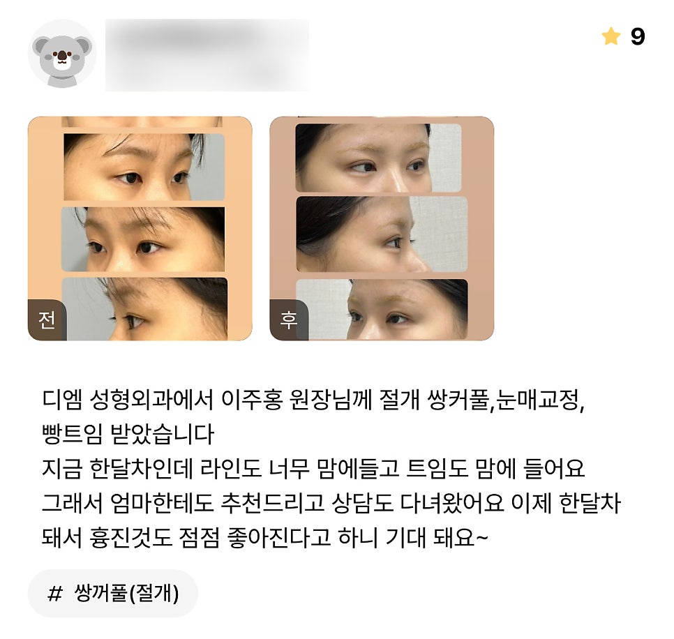 Double-Eyelid Surgery Review: “I Love Both the Crease and the Degree of Canthoplasty!” image 1