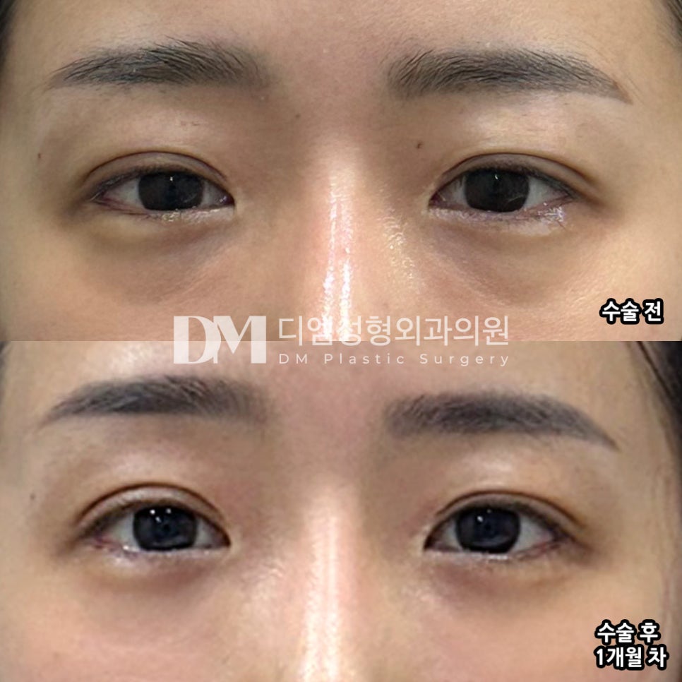 Under-Eye Fat Repositioning Review. "I Didn't Know It Would Be This Satisfying!" image 2