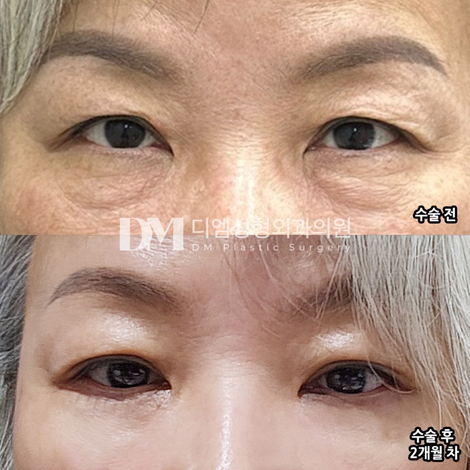 하안검 후기."인생 첫 수술이라 걱정이 많았지만 잘했다는 생각이 들어요!" 관련 이미지 2