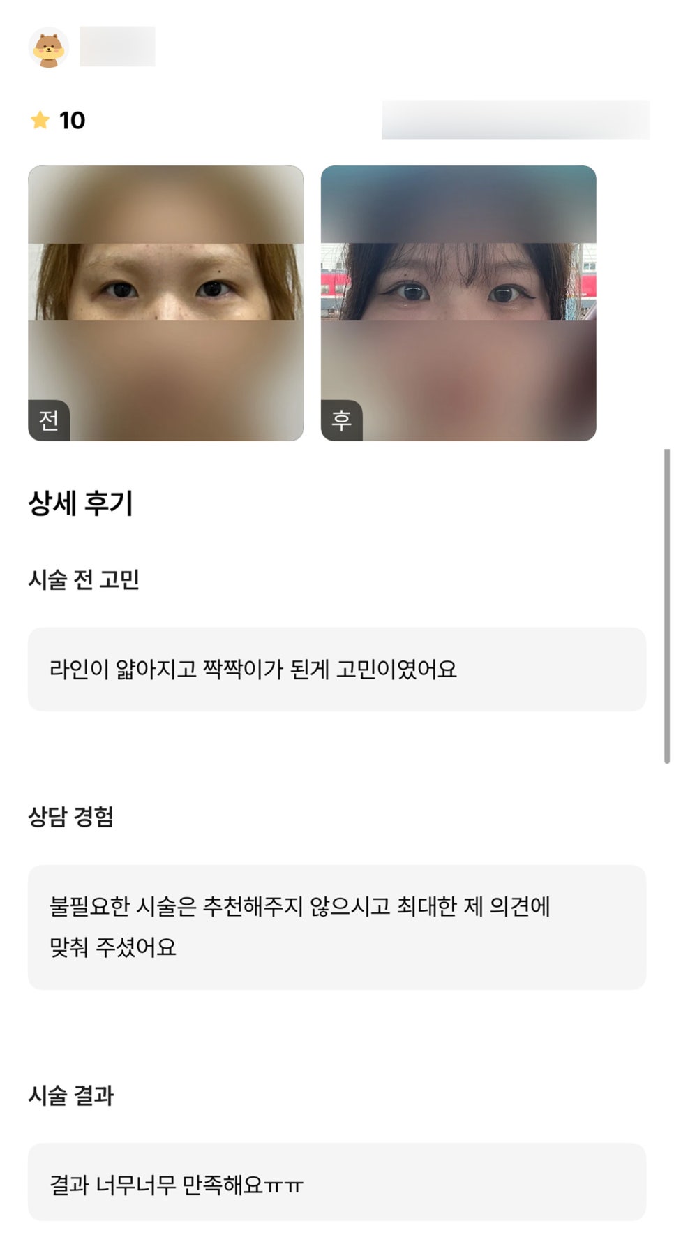 눈재수술 후기."결과 너무 너무 만족해요ㅠㅠ" 관련 이미지 1
