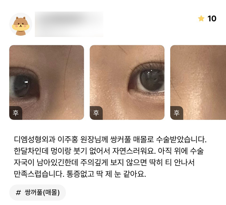 눈성형 후기."통증 없고 딱 제 눈 같아요!" 관련 이미지 1