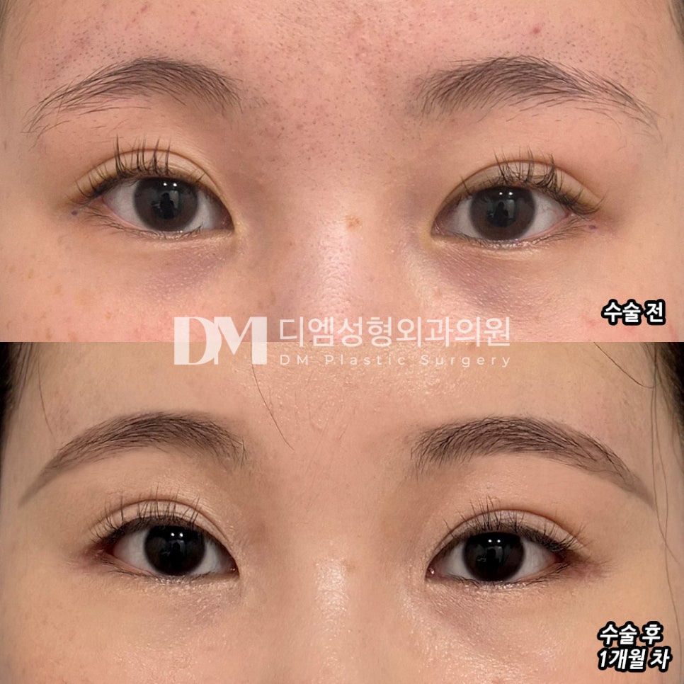 빵트임 후기."당일에도 일상 생활이 가능하고 흉터도 없어 좋았어요!" 관련 이미지 2