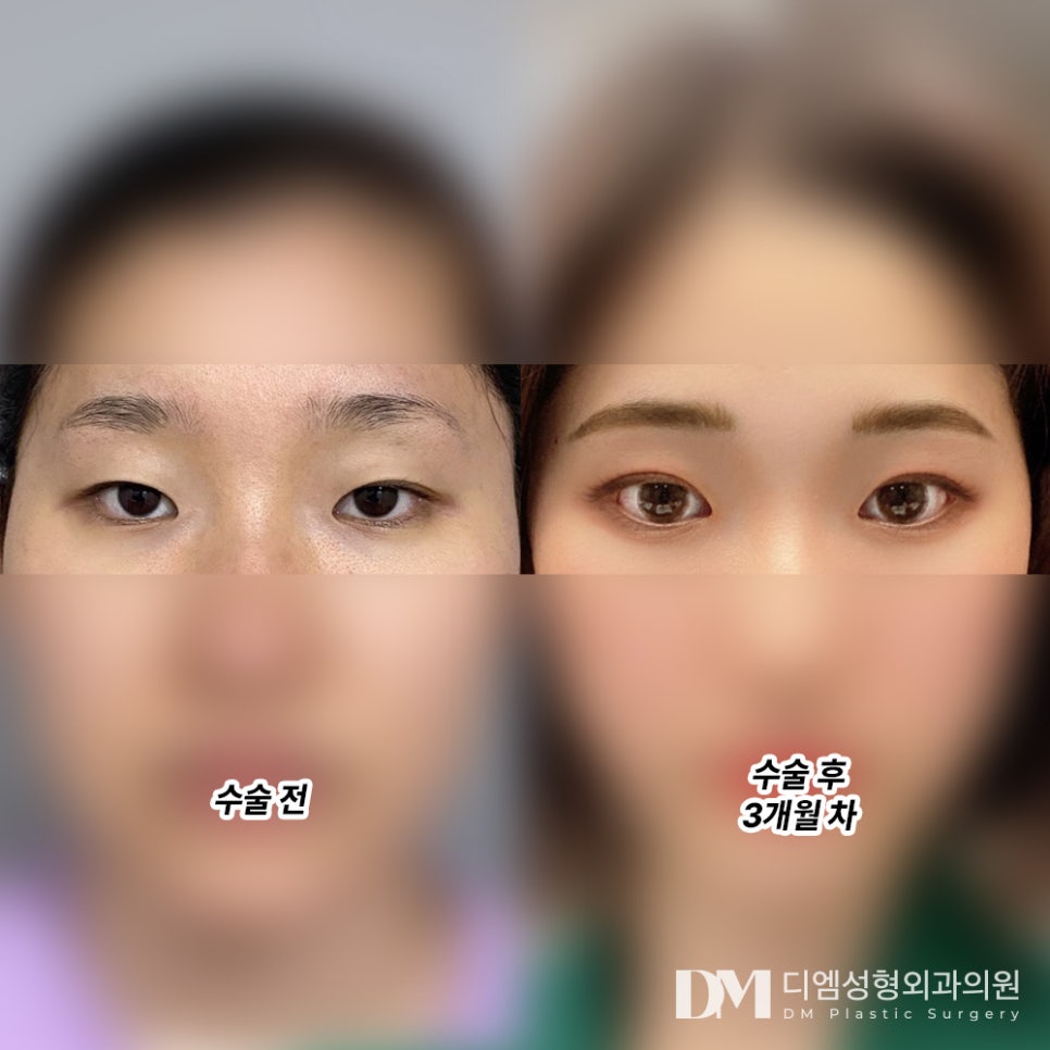 Double Eyelid Surgery: A Customized Line That Suits My Eyes image 10