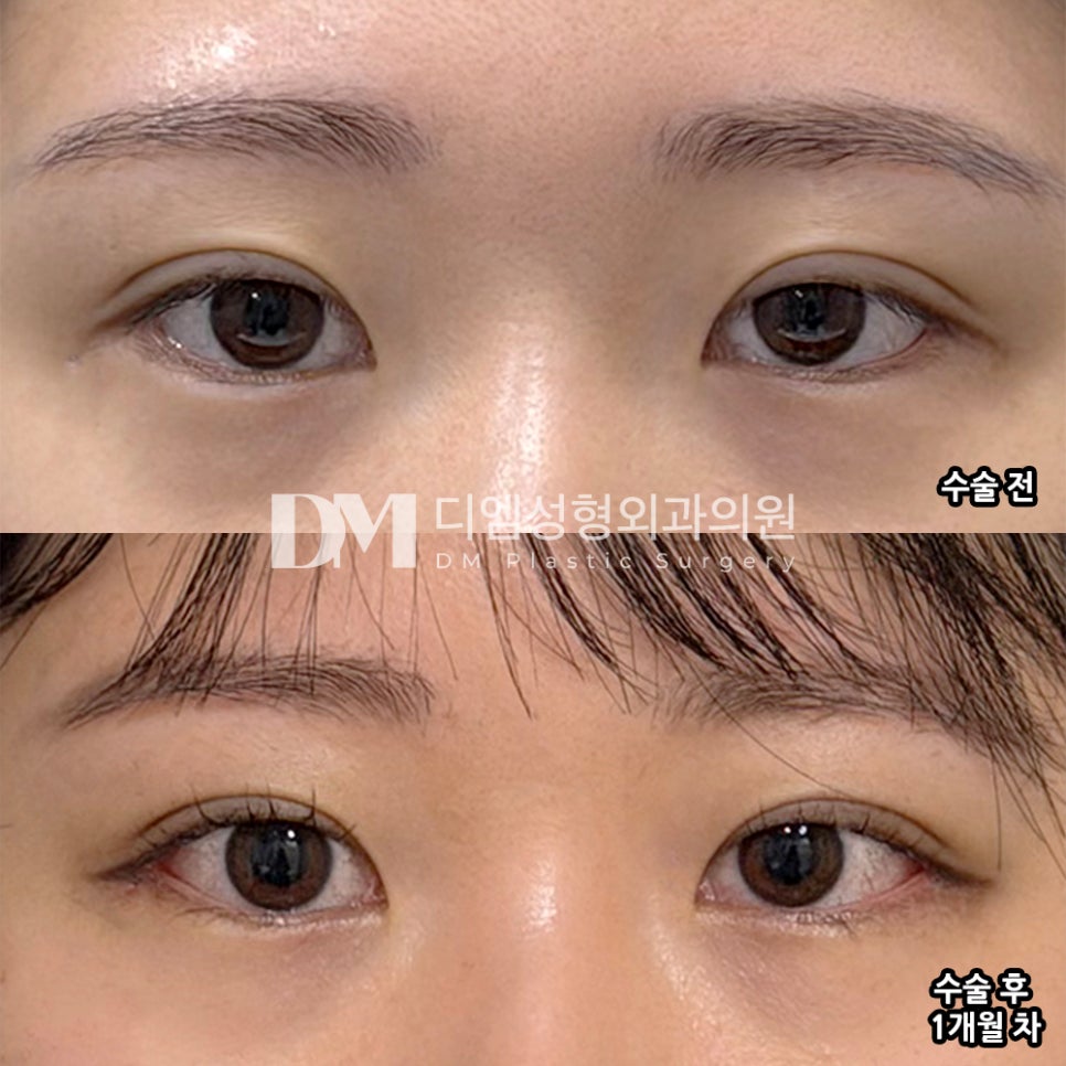 DM Revision Canthoplasty Before-and-After Photos: Afraid It Might Fail Again? image 2