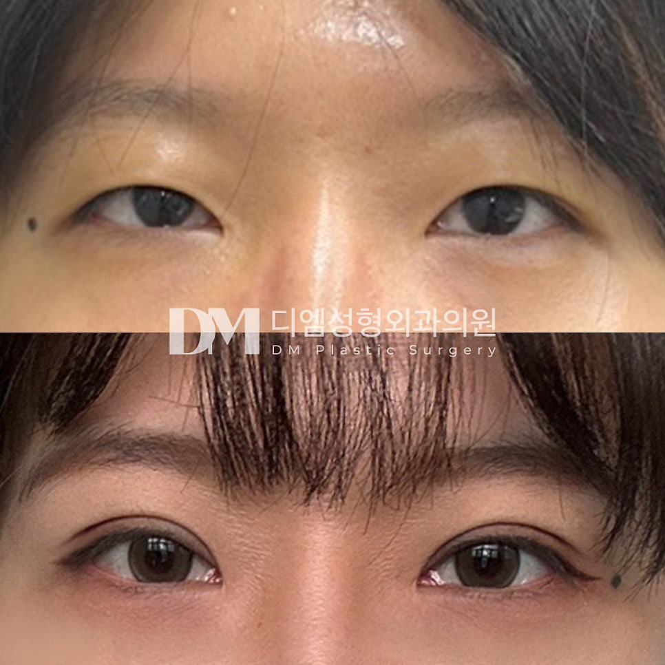 눈성형 후기."처음 라인 그대로 깔끔하게 자리잡아서 만족해요!" 관련 이미지 2