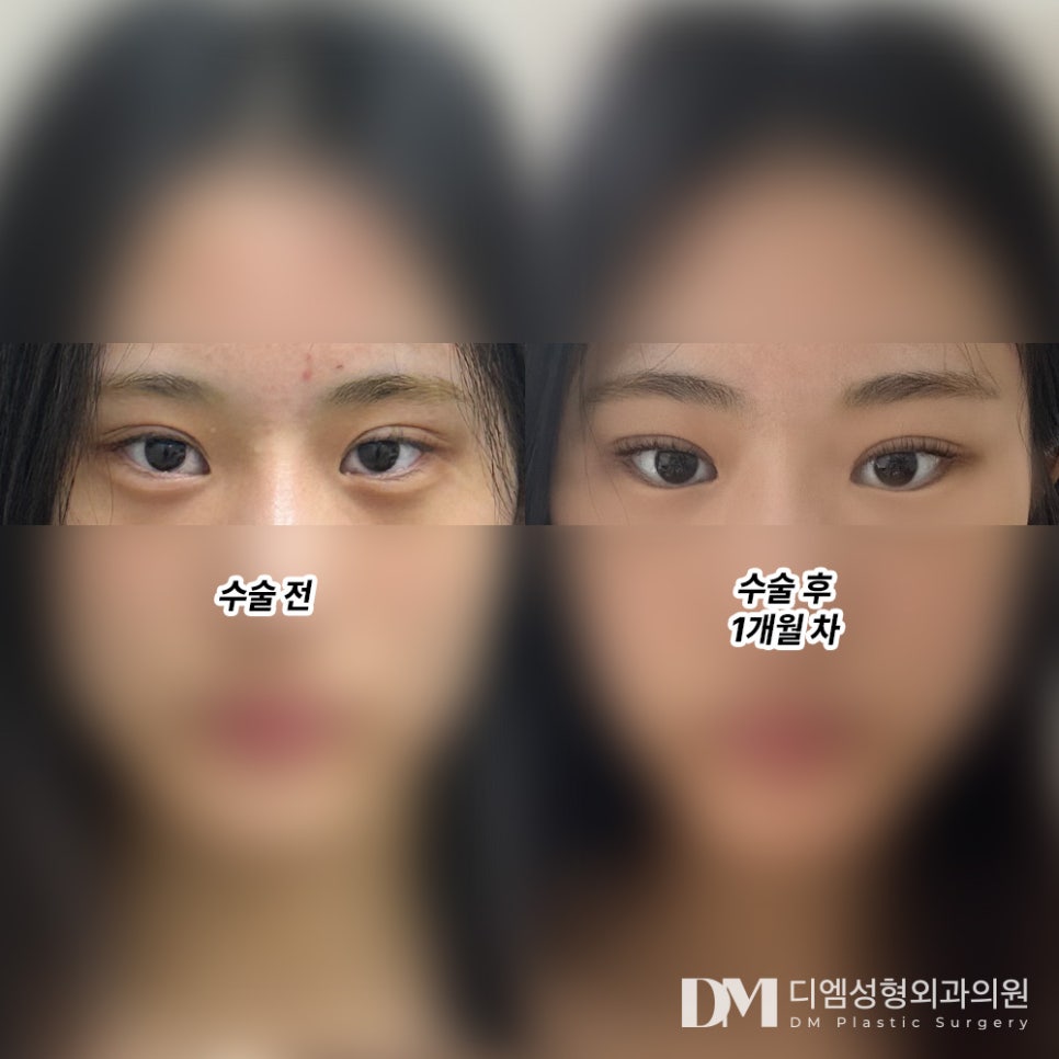 Double Eyelid Revision Surgery Review. "The director defined the line well, and there was little swelling, so I was able to return to daily life quickly, which I liked!" image 2