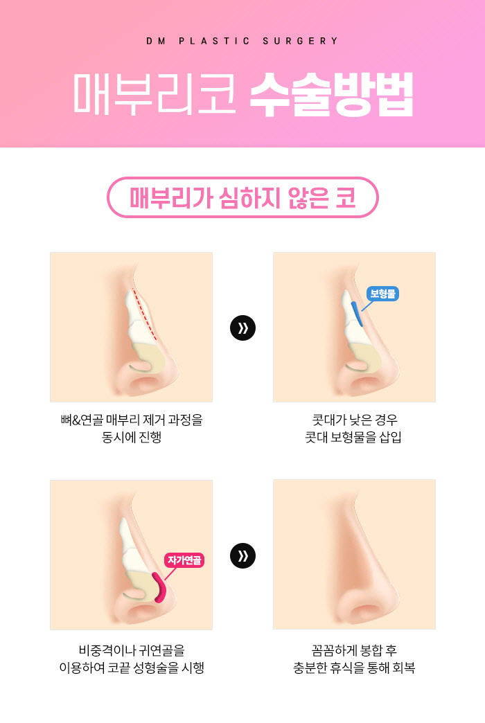 Perfecting Hump Nose Surgery with a Customized Surgical Plan image 6