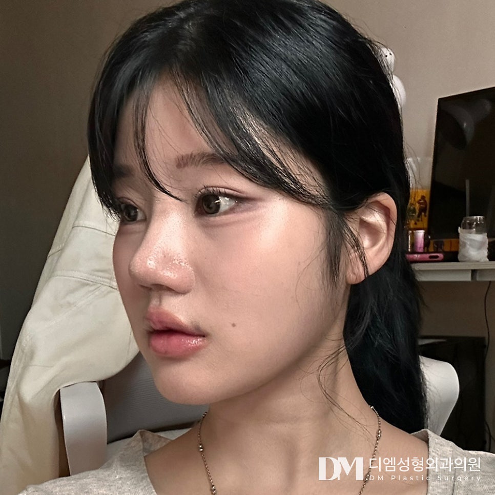 긴코성형, 짧은 중안부로 동안 되기 관련 이미지 10