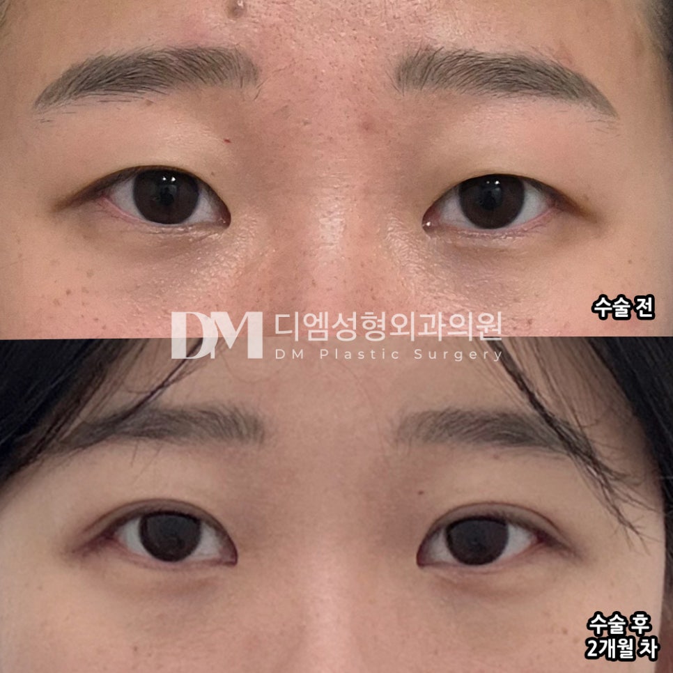 눈재수술 후기."라인이 마음에 들고 전체적으로 만족합니다!" 관련 이미지 2