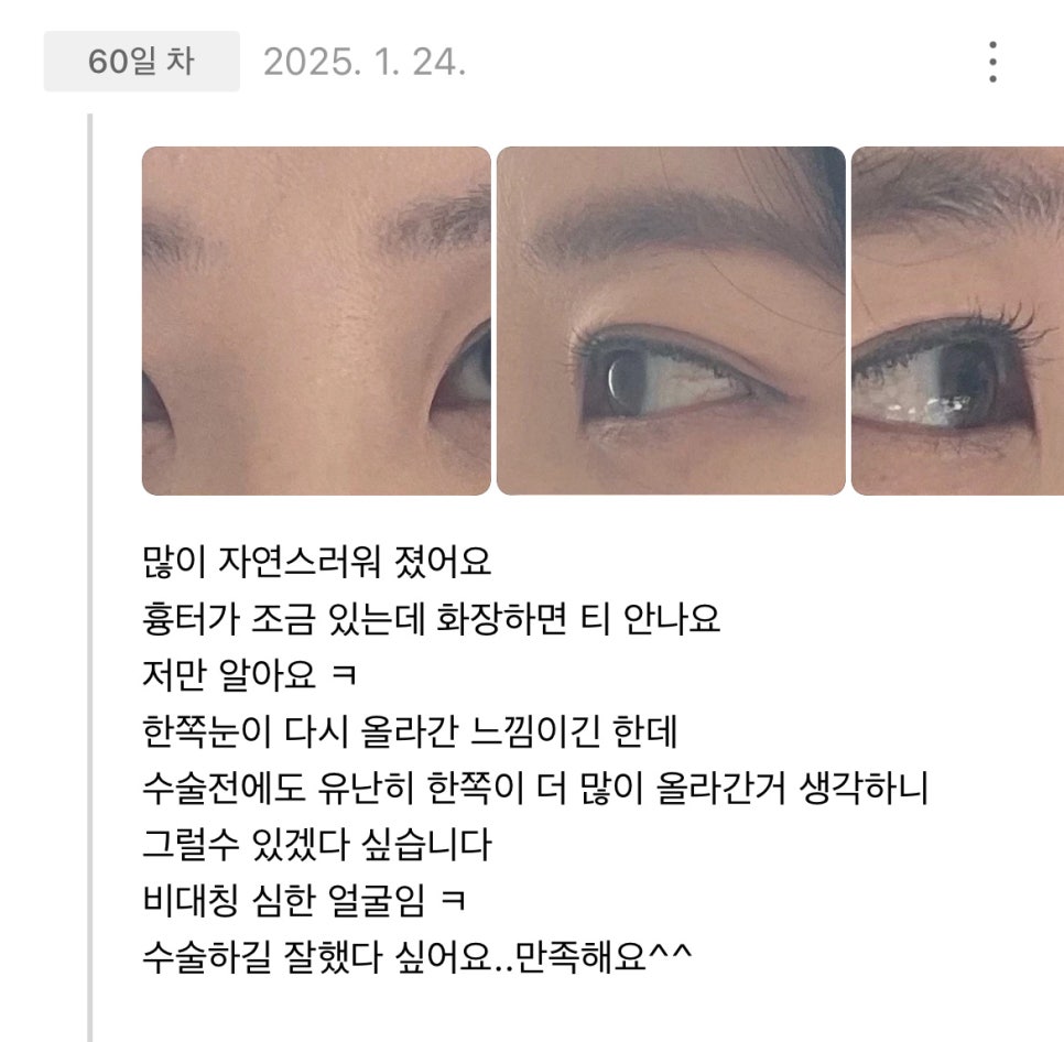 빵트임 후기."수술하길 잘했다 싶어요 만족해요!" 관련 이미지 1