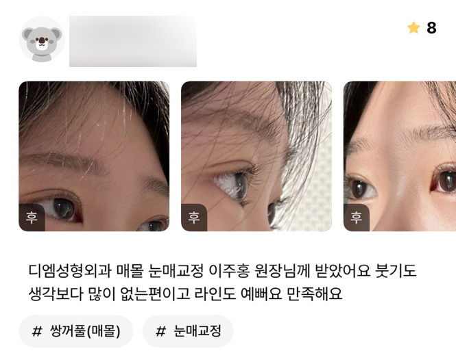 Eye Surgery Review: “There’s less swelling than I expected, and the crease looks nice too. I’m satisfied.” image 1