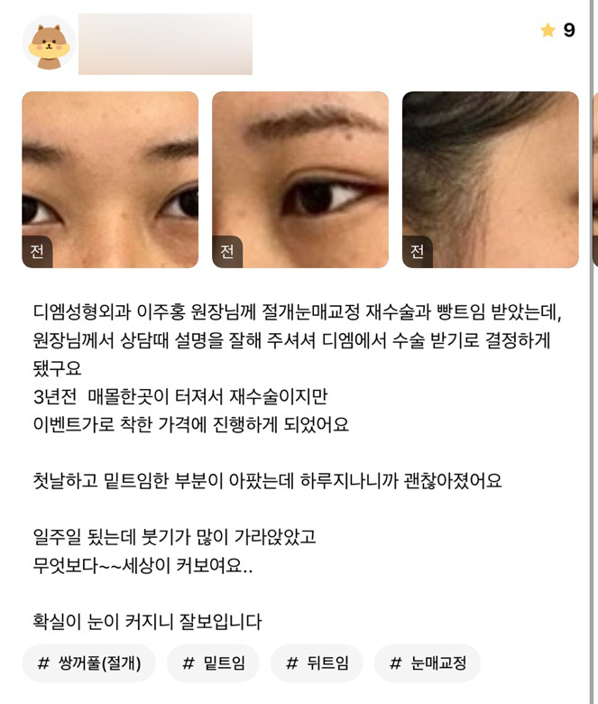 눈성형 후기."눈이 커지니 세상이 잘보여요!" 관련 이미지 1