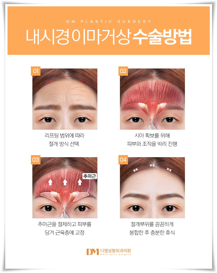 이마거상, 이마 주름과 처진 눈매를 한번에 교정하고 싶다면? 관련 이미지 6