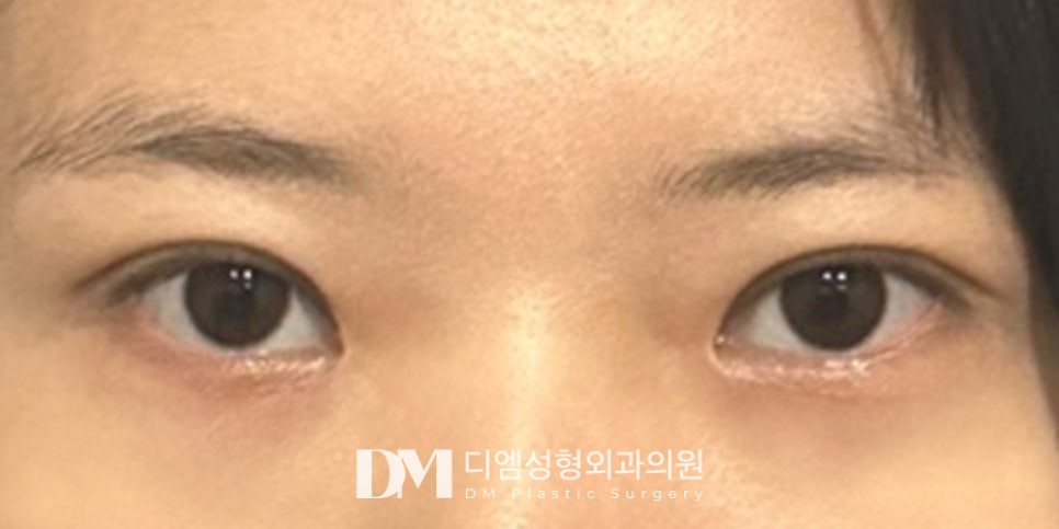 Double-Eyelid Surgery: How to Get It Right the First Time?! image 9