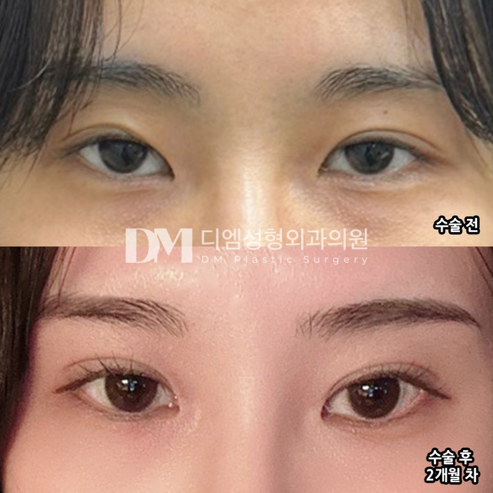 눈재수술 후기."너무 과하지않고 딱 제 눈처럼 수술되어서 넘 만족스럽습니다!" 관련 이미지 2