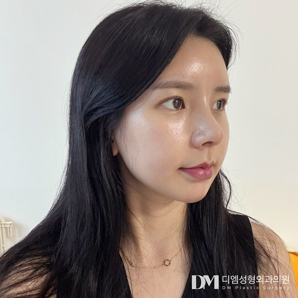 Creating a Sophisticated Nose Shape with Tip Rhinoplasty image 12