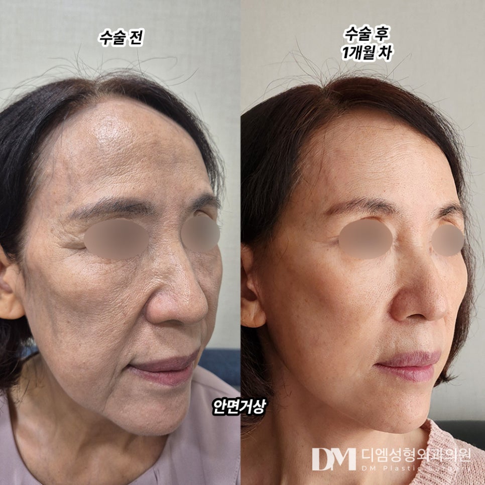 Facelift Surgery: Regain Firmness in Sagging, Lax Skin and Restore a Youthful Look! image 6