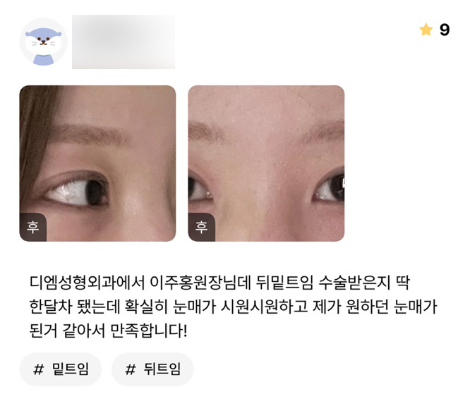 Wide-Opening Canthoplasty Review: “I’m satisfied because my eyes definitely look more open and refreshed, and I feel like they have the look I wanted!” image 1