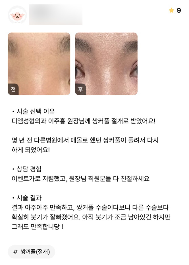 눈재수술 후기."붓기도 잘빠지고 만족합니당!" 관련 이미지 1