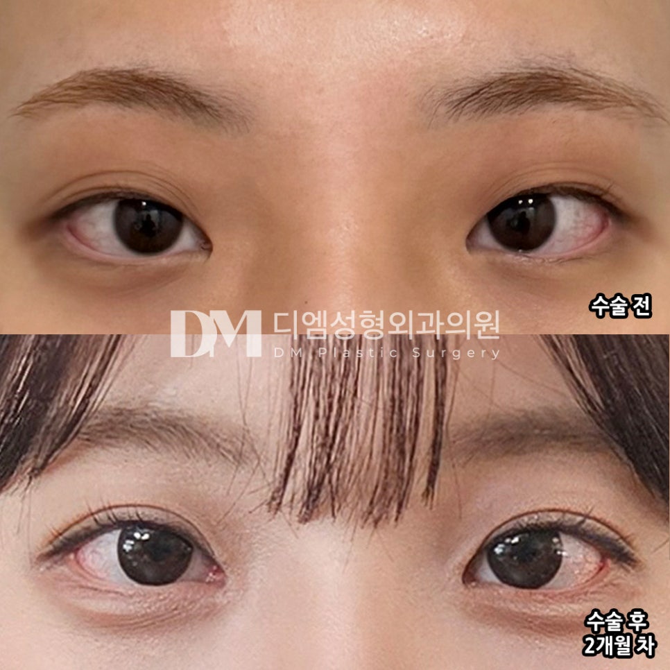 Eye Correction Surgery: Transform a Dull, Heavy-Looking Eye Shape into a Clear, Brighter One! image 6