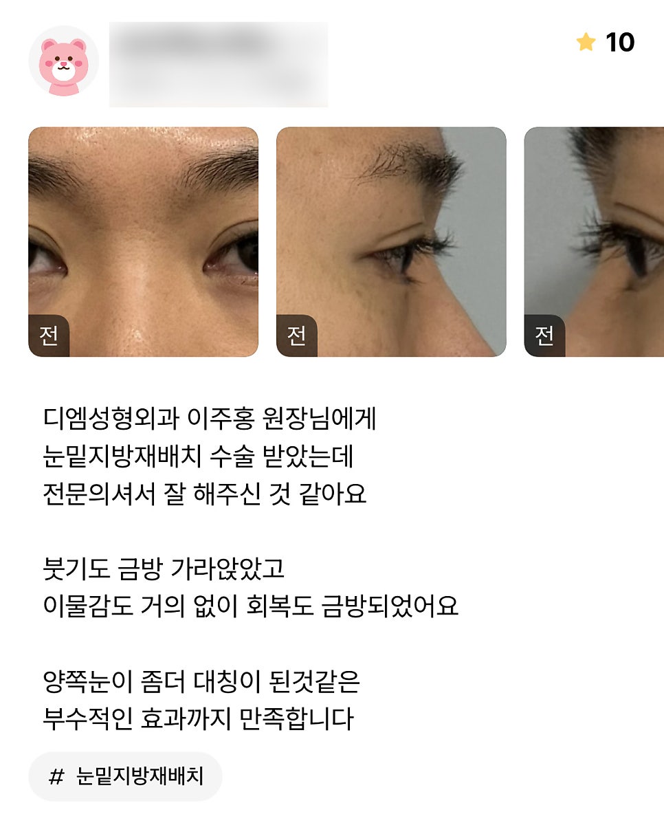 눈밑지방재배치 후기."양쪽 눈이 좀 더 대칭이 된 것 같은 부수적인 효과까지 만족합니다!" 관련 이미지 1