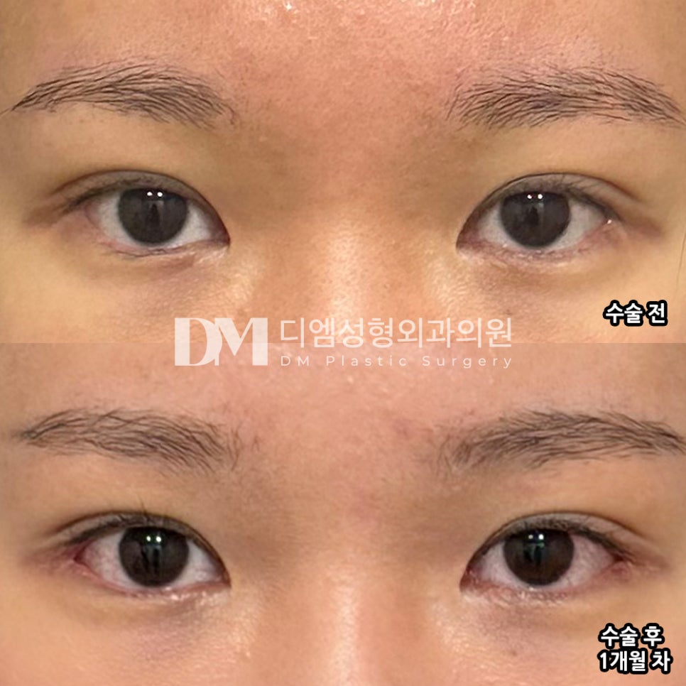 DM Canthoplasty Revision Surgery Review, “I’m glad the eyes look more open both in photos and in real life!” image 2