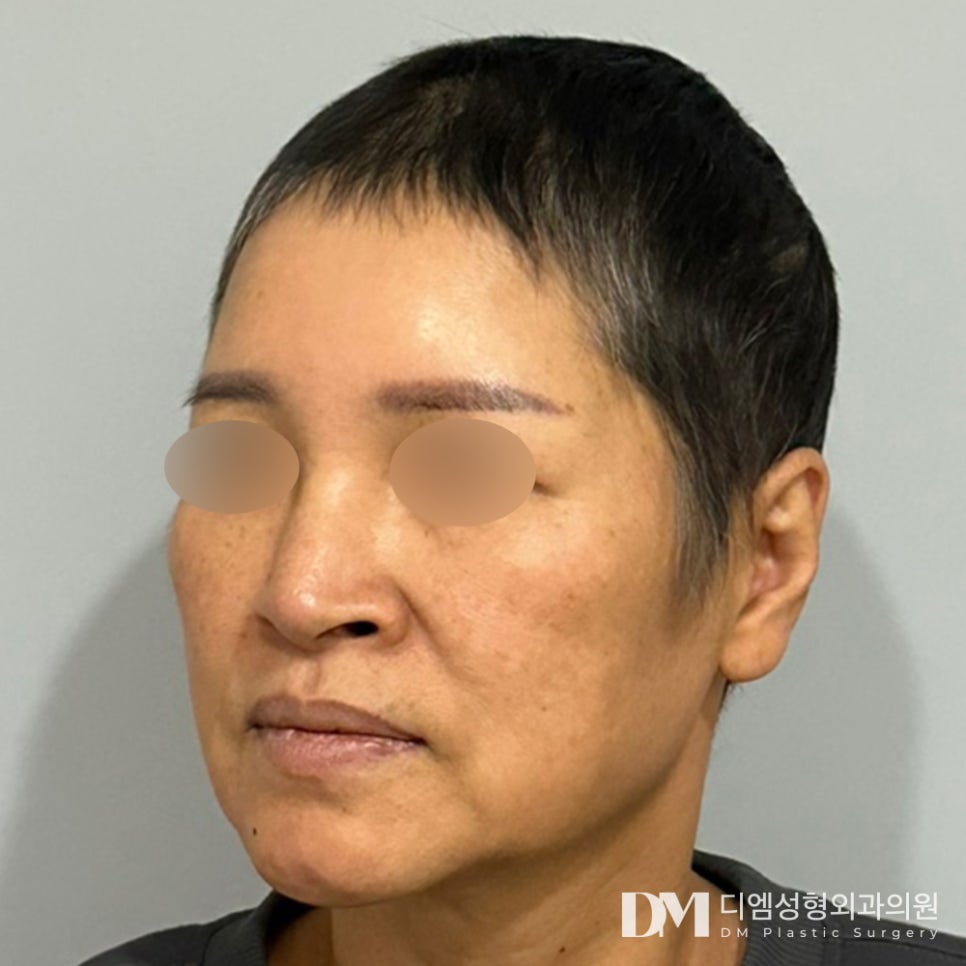 안면거상술 , 중년 처짐 개선하기 관련 이미지 6
