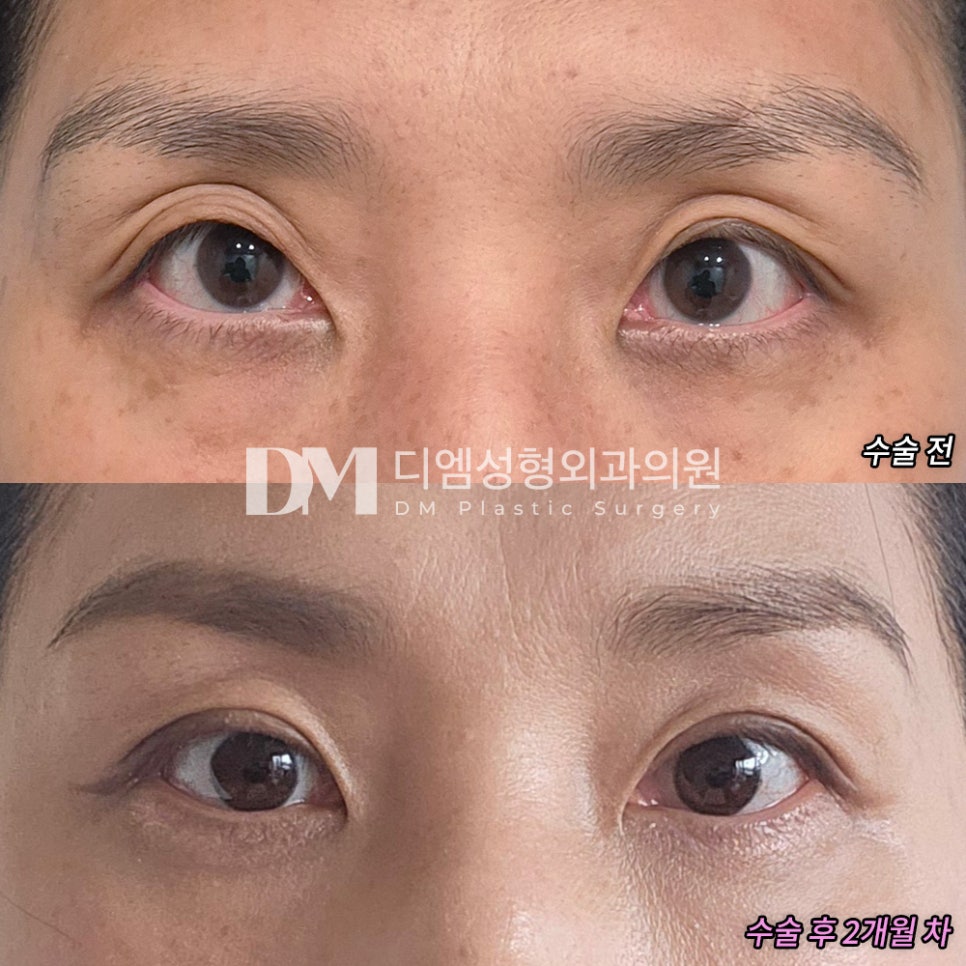 눈재수술 후기."꼭 필요한 시술만 합리적으로 받을 수 있어 좋았어요!" 관련 이미지 2
