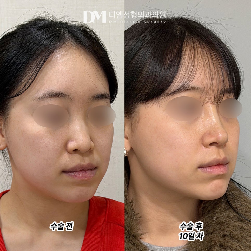 디엠 코성형 전후사진, 이목구비가 확 살아보이는 비결은? 관련 이미지 2