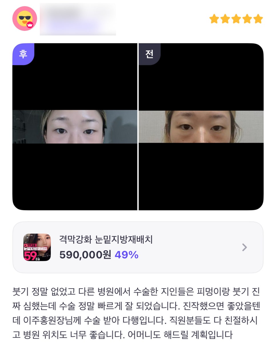 눈밑지방재배치 후기."수술 정말 빠르게 잘 되었습니다. " 관련 이미지 1