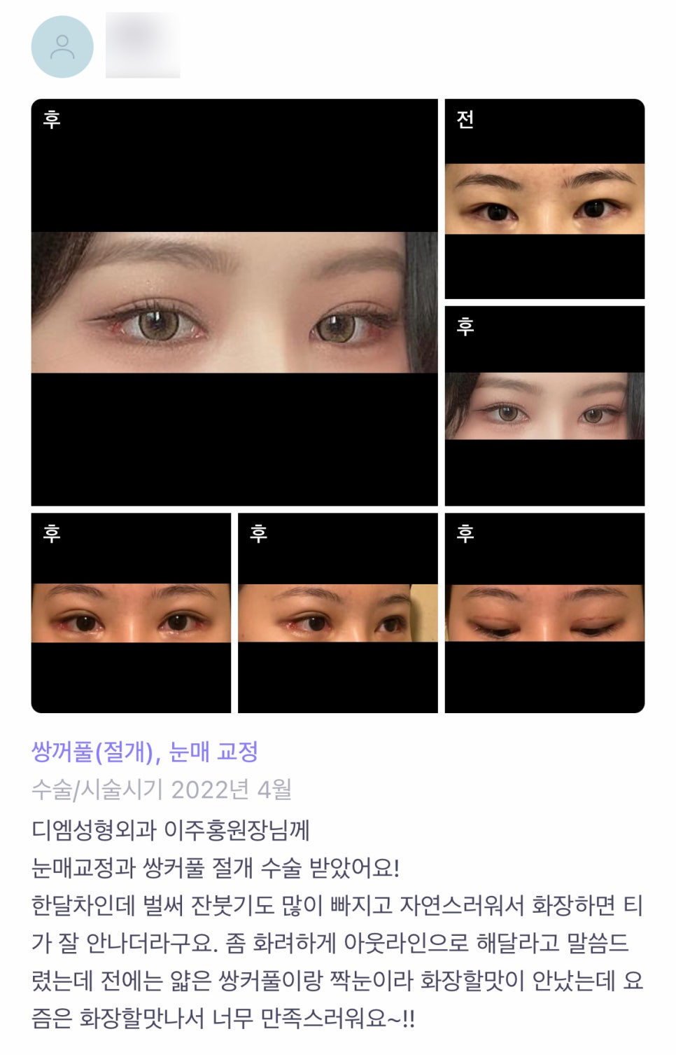 눈성형 후기."요즘 화장할 맛 나서 너무 만족스러워요~!" 관련 이미지 1