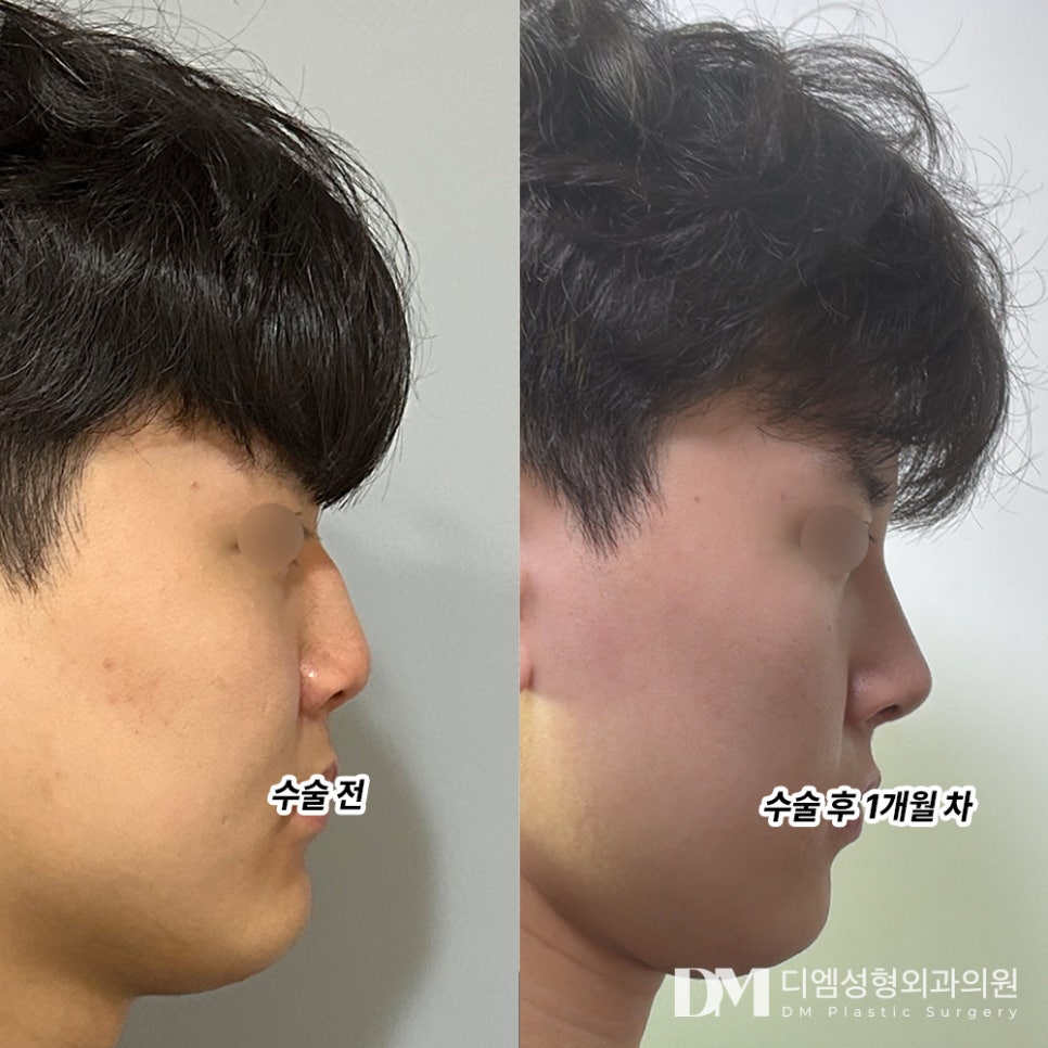 Rhinoplasty Review. “It didn’t hurt, and I’m very satisfied with the result!” image 2