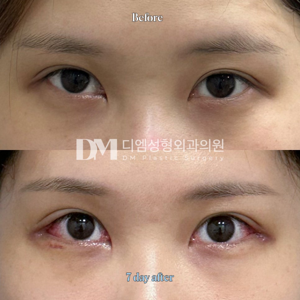 뒤밑트임 후기."뒷밑트임 고민하시는 분들 고민없이 추천!" 관련 이미지 2